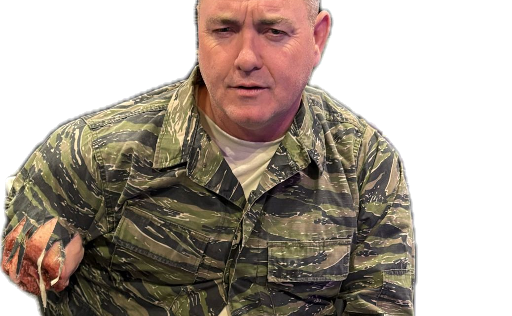 Amputated Upper Arm Prosthetic #101 on model