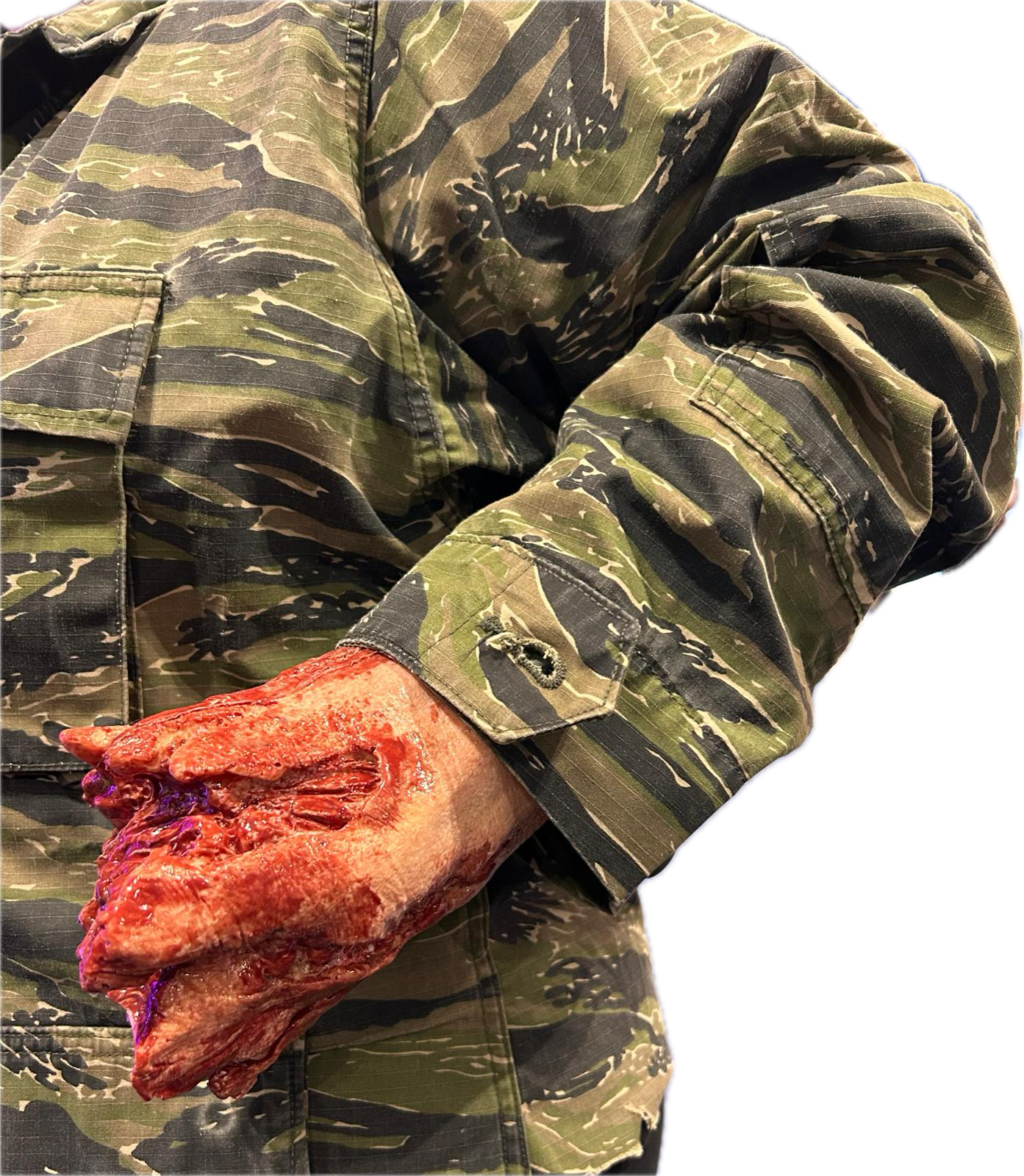 Hand Amputation Prosthetic #100 on model