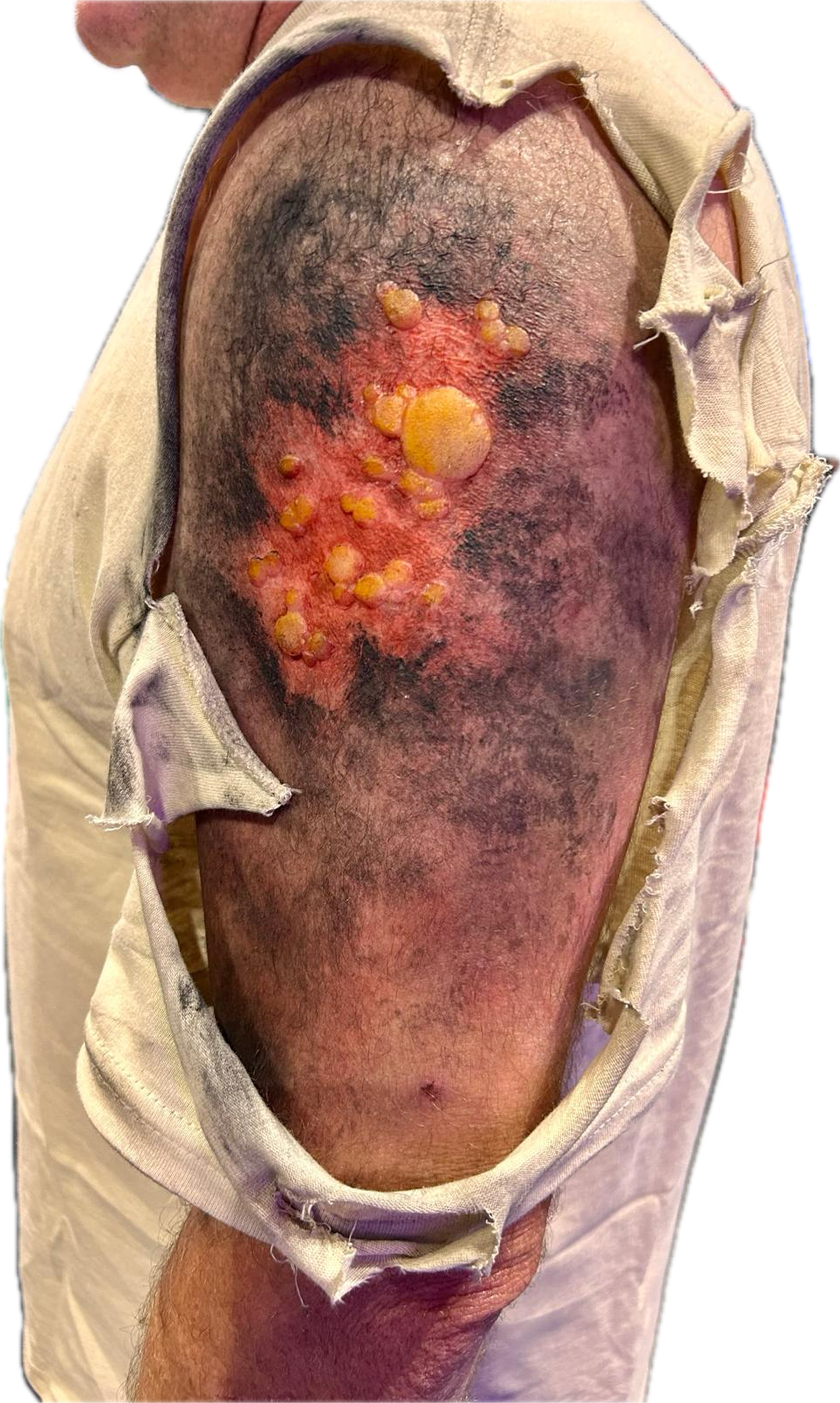 2nd Degree Burn Blistering