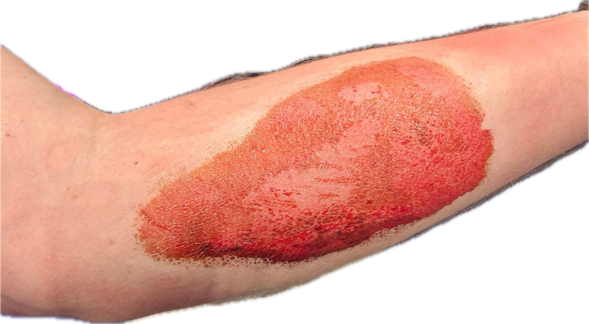 2nd Degree Burn on Arm