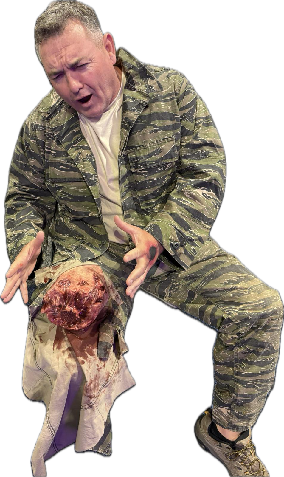 Amputated Upper Leg Prosthetic #102 on model