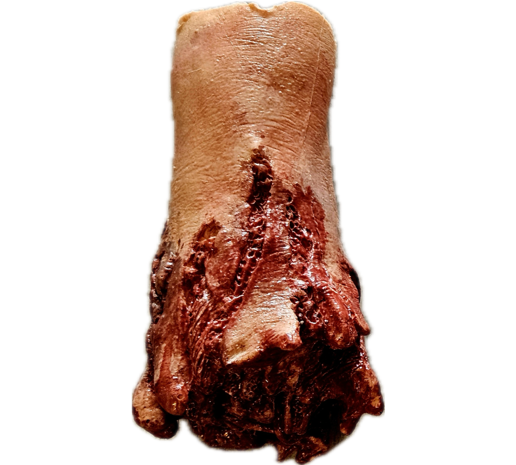 Hand Amputation Prosthetic #100