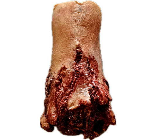 Hand Amputation Prosthetic #100