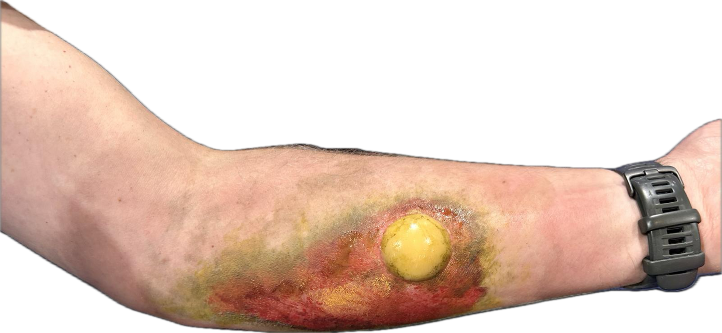 Mustard Gas Burn and Blister