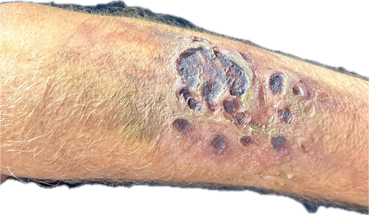 Septic Arm Wound