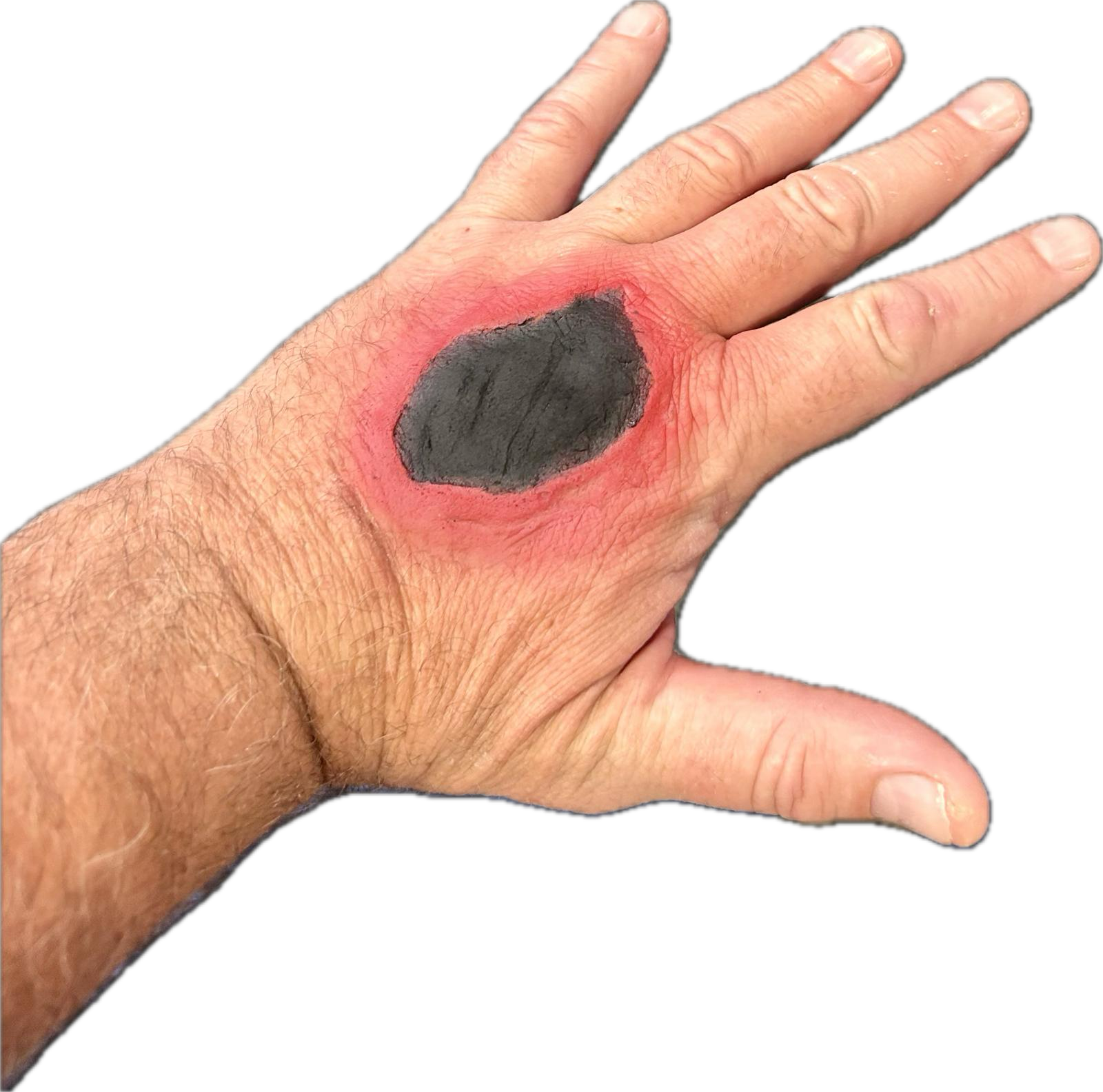 Subcutaneous Anthrax Hand Wound